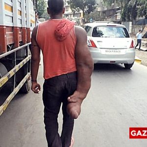 Hindistan’ın Bombay kentinde yaşayan 25 yaşındaki Bablu, kısmi irilik rahatsızlığına