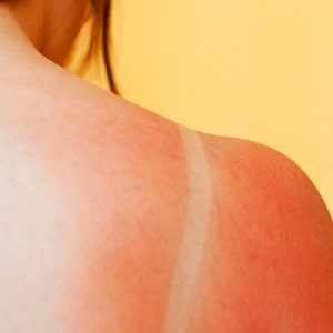 Güneş ışınlarından korunmanın cilt sağlığı açısından son derece önemli olduğunu